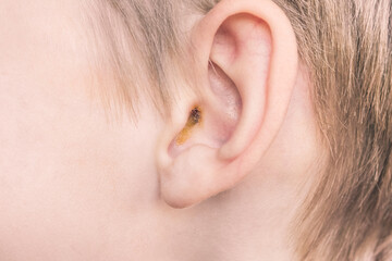 earwax in a dirty ear of child close up. ear hygiene