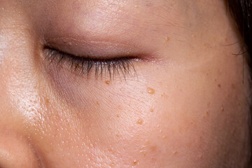 Seborrheic keratosis, pore, acne and wrinkles in face woman skin. Facial skin problems background concept.