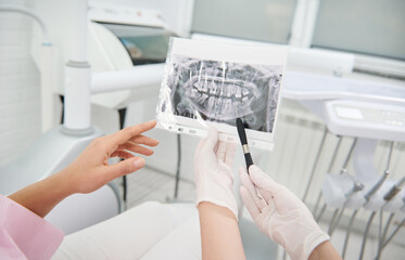 Focus on X-ray photograph in the hands of a dentist showing jaw and teeth, discussing with a patient during dental examination, explaining the consultations treatment issues. Diagnostics in dentistry