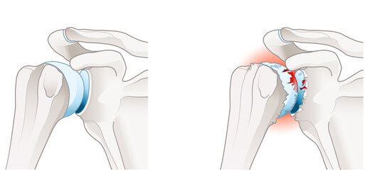 Osteoarthritis of the shoulder joint - obrazy, fototapety, plakaty