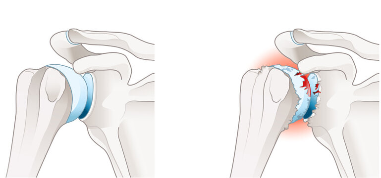 Osteoarthritis of the shoulder joint