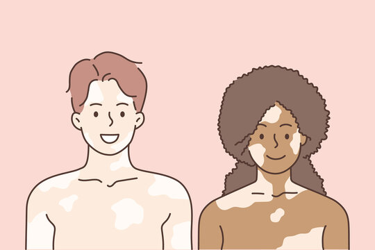 Vitiligo and mixed race love concept. Young smiling woman and man couple standing together having vitiligo on faces and bodies feeling love vector illustration 
