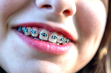 Happy teenage girl pointing on her dental braces. Young teenage girl smiles and points a finger at the dental braces on her teeth
