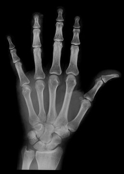 x ray image of hand