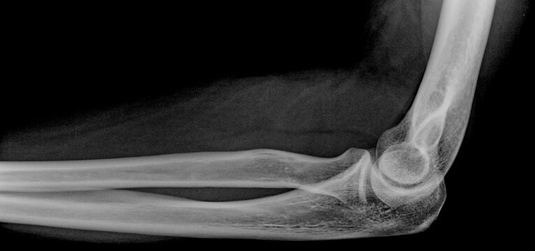x ray image of human elbow joint