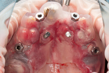 Mounted Dental Implants through the Surigious Top Jaw Template