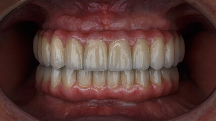 Installed ceramic Dental Prostheses of the upper and lower jaw in the bite in the patient oral...