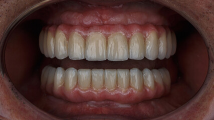 Beautiful composition on the installed ceramic dental prostheses of the upper and lower jaw