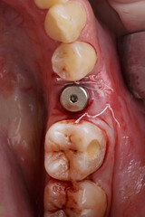 Installed Dental Implant and gum shaper in the field of chewing tooth