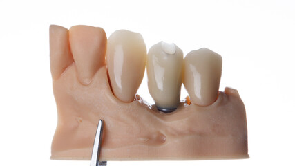 Temporary dental crowns on the model, shot on a white background