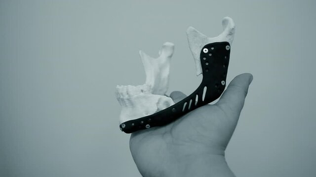 Person holding in hand facial mandibular endoprosthese printed metal 3D printer