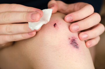 Wounds on a woman's leg. Women's hands treat a wound after a fall