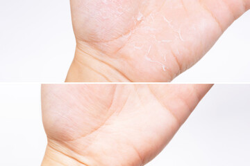 Close-up of a female hand before and after treatment of peeling skin on the palm isolated on a white background. Allergies, eczema, psoriasis, vitamin deficiency, erythema