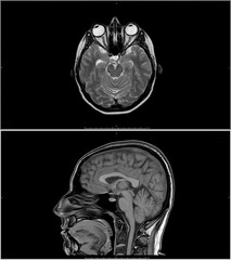 MRI scan or magnetic resonance image of head.
Problems with the brain stem and pituitary gland.