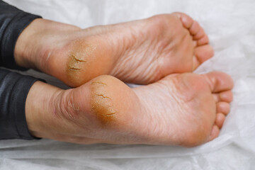 Cracked heels in a woman. Medical pedicure in the salon. Problematic sore foot with dry skin. Photo...