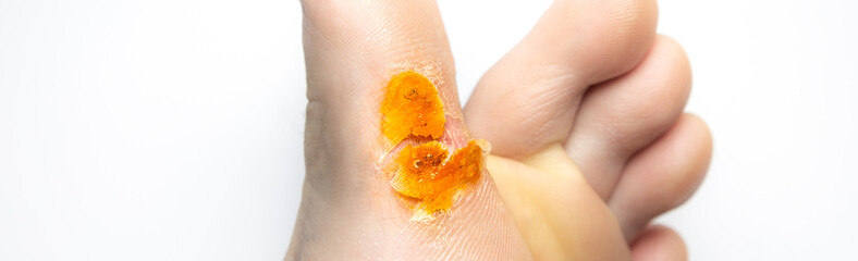 Contagious skin illness on foot. Medical treatment photo..Close up photo of plantar wart on man's foot. Salicylic acid plaster. Remove  Verruca plantaris.