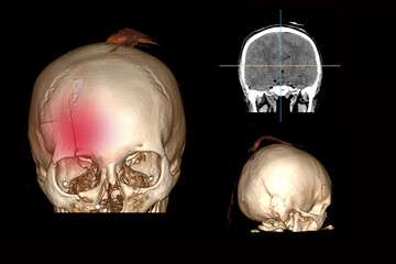 3d computed tomography of the brain with a fracture of the frontal part of the skull after...