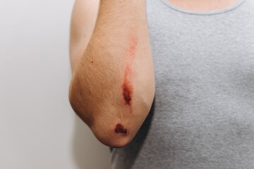 Large abrasions on the forearm of a man after a fall.