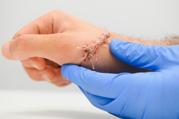 Suture wound on hand,Pain of accident concept