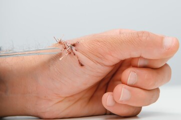 Suture wound on hand,Pain of accident concept