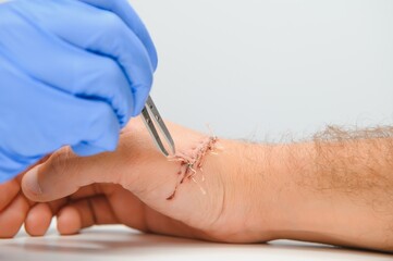 Suture wound on hand,Pain of accident concept