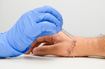 Suture wound on hand,Pain of accident concept