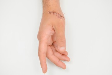 wound hand, suturing the wound. The type of cut after surgery.