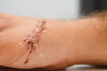 Suture wound on hand,Pain of accident concept