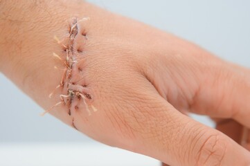 Suture wound on hand,Pain of accident concept