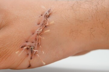 Close-up of a hand wound with stitches