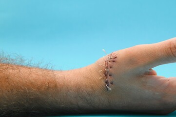 Suture wound on hand,Pain of accident concept