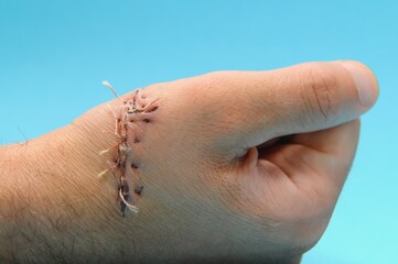 Suture wound on hand,Pain of accident concept