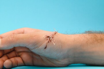 Suture wound on hand from dermatology procedure