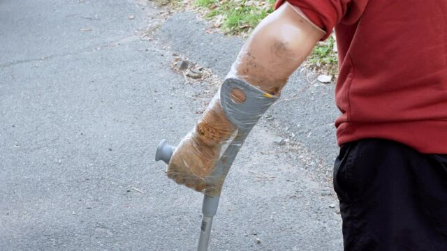 A man living with a disability with amputated legs and arms walks at street on modern artificial bionic legs prosthesis using old plastic arms tied to crutches with sticky tape