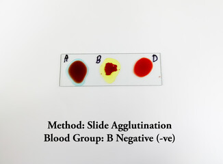 Blood group and Rh factor testing by slide agglutination method. Blood typing. B negative.