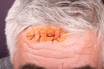 a surgical suture treated with iodine solution on the forehead of an elderly man close-up wound care