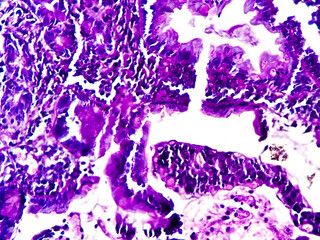 Squamous cell carcinoma of a human, photomicrograph panorama as seen under the microscope, 200x...