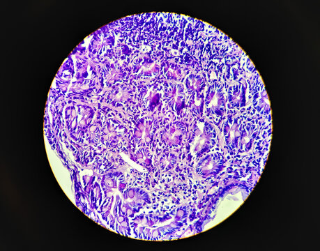 Squamous cell carcinoma of a human, photomicrograph panorama as seen under the microscope, 200x zoom.