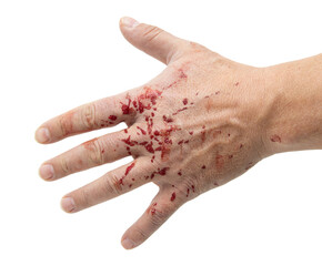 drops of blood on a hand on a white background