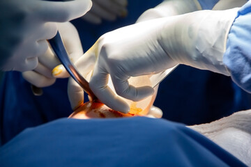 Open breast surgery, placing a prosthesis. Close-up of the breast and the hands and tools of the doctors.