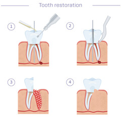 Tooth treatment, step by step instructions. Hemisection, root removal, modern dentistry. Vector illustration for dental textbooks