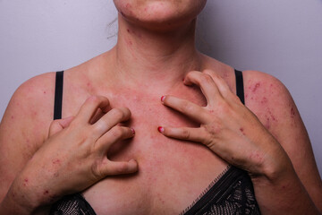 atopic dermatitis. the girl combs her neck due to severe exacerbation and itching