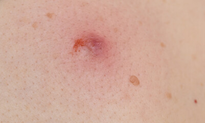 skin after extraction of a large tick.  Ixodes ricinus. Dangerous insect mite. Encephalitis, Lyme...