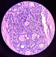 Microphotograph(microscopic image) of Nodular goitre with adenomatous change in thyroid tissue, 40x view