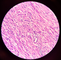 Microscopic image of chronic epididymo-orchitis in testis tissues, showing testicular tissue and epididymis, acute and chronic inflammatory cells and peritubular fibrosis present