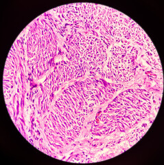Obraz premium Microscopic image of chronic epididymo-orchitis in testis tissues, showing testicular tissue and epididymis, acute and chronic inflammatory cells and peritubular fibrosis present