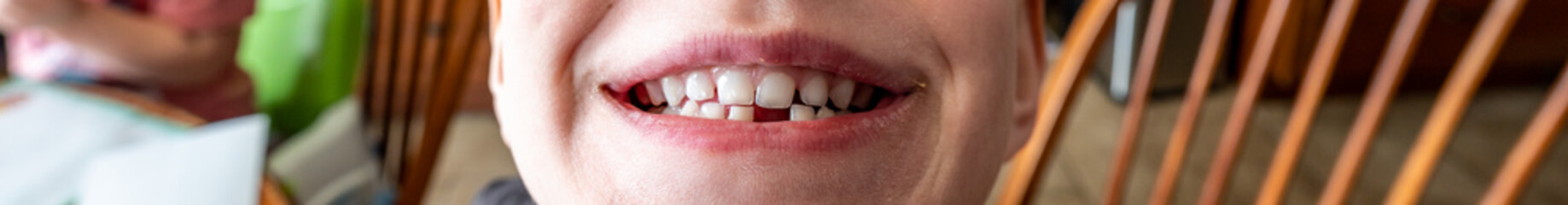 Obraz premium Lower front incisor baby tooth gap showing gums and socket