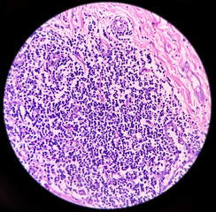 Microscopic image of Hidradenitis suppurativa in axillary mass tissues.  showing hyperplasia of follicular epithelium, dermal inflammatory cell infiltrate present
