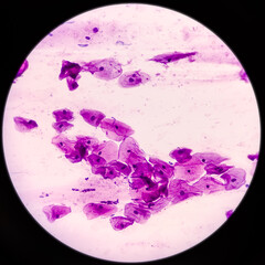 Cervical smear (paps) cytology at histopathology laboratory. Microscopic 40x objective view of...