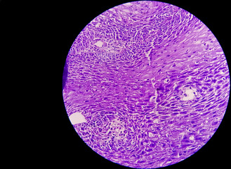 Pancreas Cancer Awareness: Photomicrograph of CT scan-guided fine needle aspirate (FNA) cytology of a pancreatic mass showing malignant cells indicating adenocarcinoma.